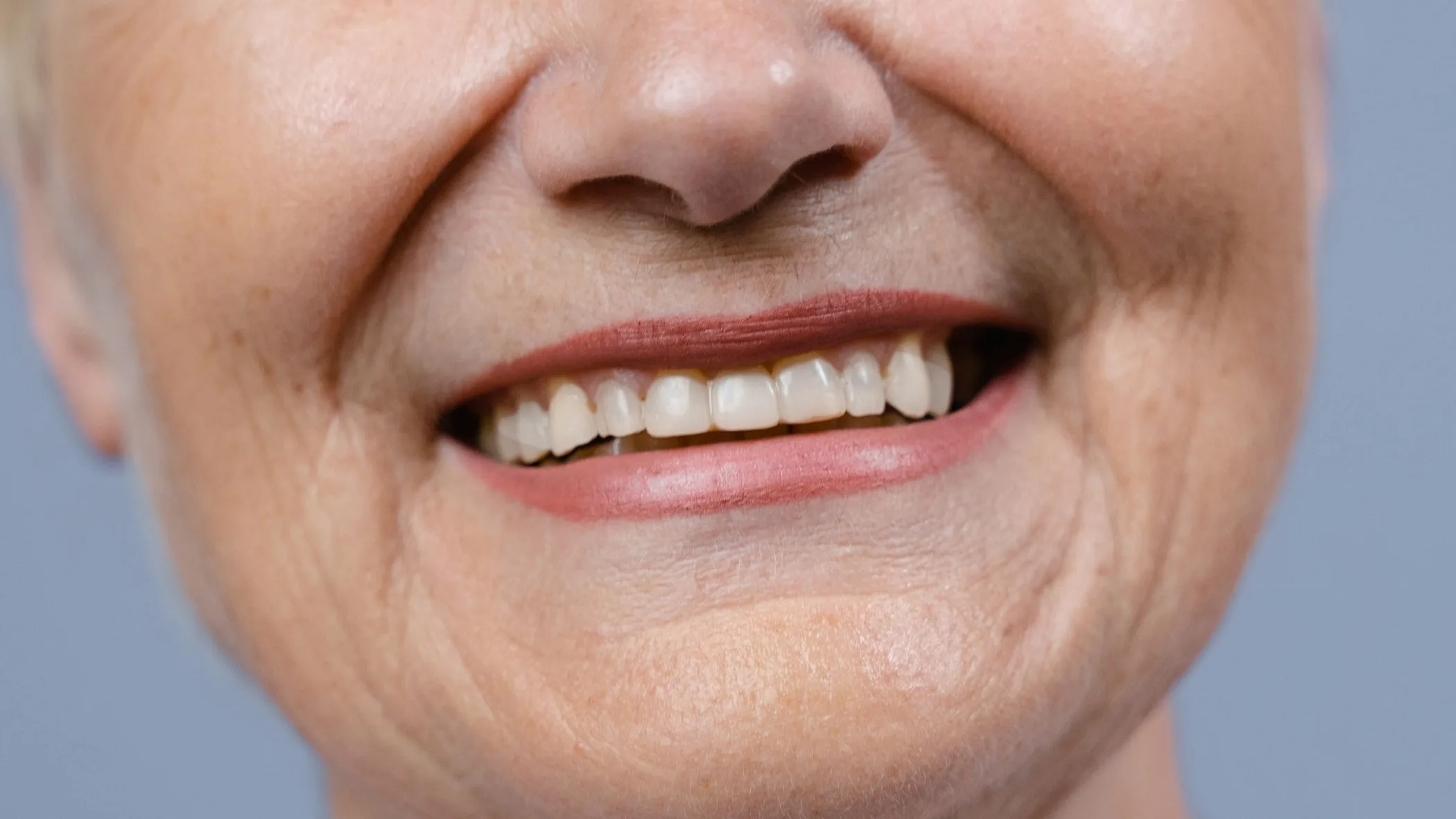 A close-up of a woman&rsquo;s smile after three weeks of home whitening, the teeth several shades lighter