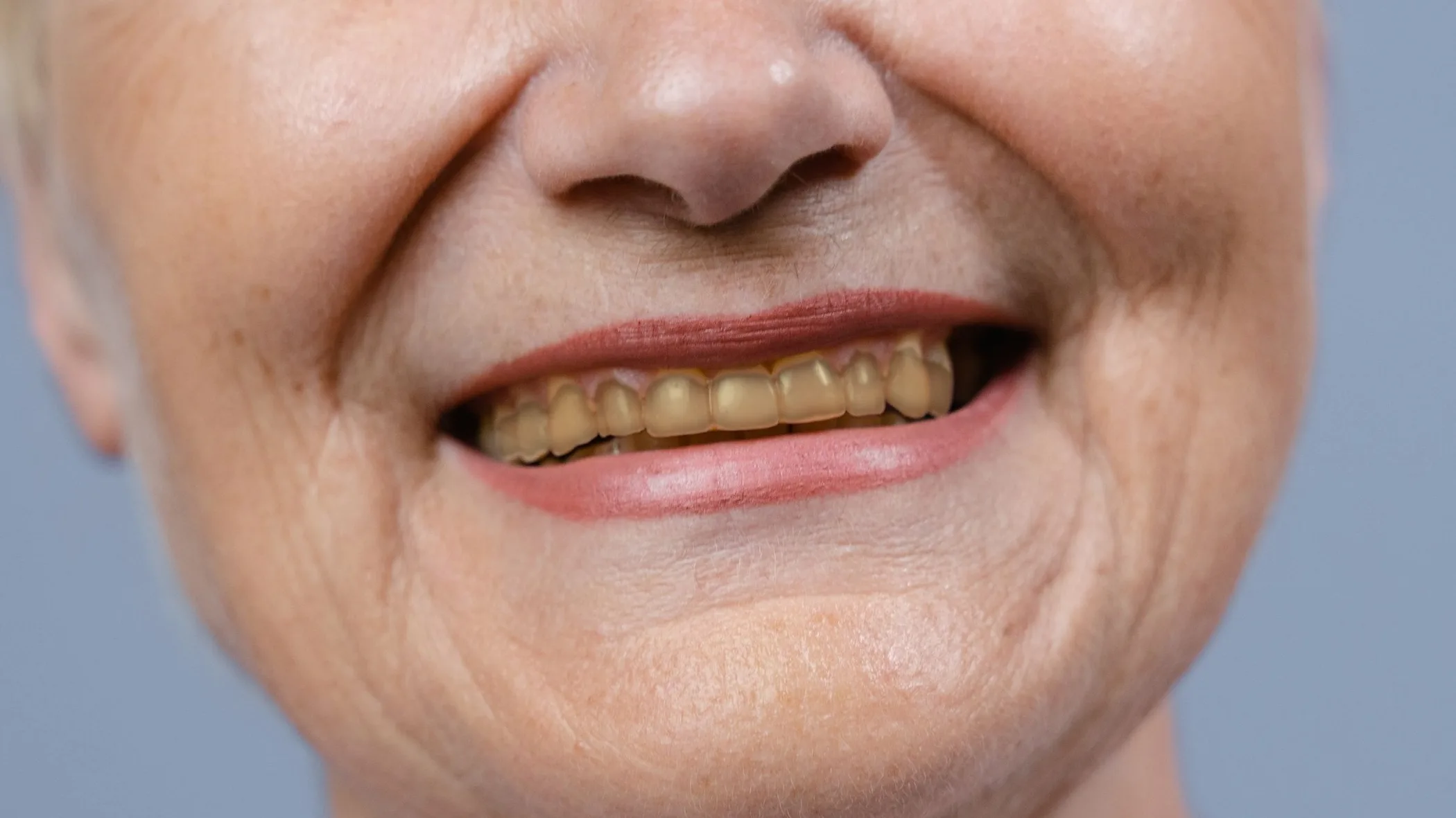 The same smile before whitening, the teeth a natural yellow with staining near the gumline