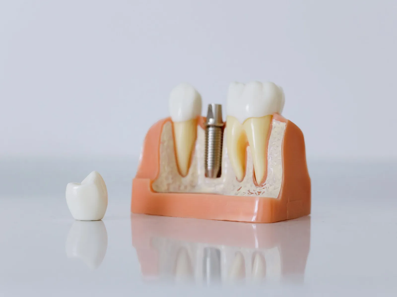 A model of a jaw showing a titanium implant in the bone beside a natural tooth, with the crown that fits it
